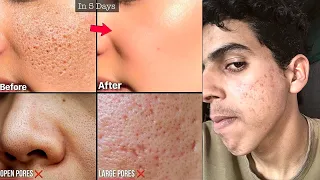 মুখের গর্ত আর ব্রন একদম পরিষ্কার করে দেবে | How To Get Rid of Large Open Pores & Marks