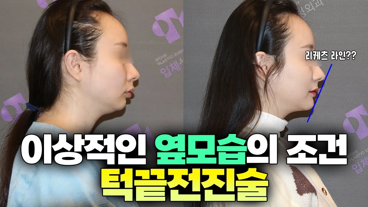 리케츠 황금라인을 위한 무턱수술의 종류와 기대효과