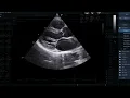Transthoracic Echocardiography TTE - A Standard Examination