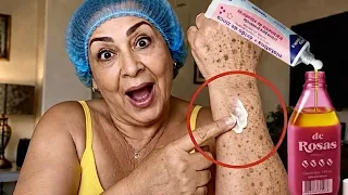 IGUAL PLÁSTICA, Tira Tudo! Manchas Pretas SOMEM em 3 DIAS USANDO! 