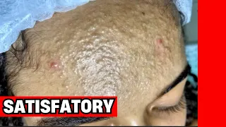 extra o de cravos satisfat ria limpeza de pele comentada por esteticista 356476