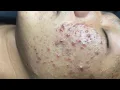 Hana A young boy had blackheads for years