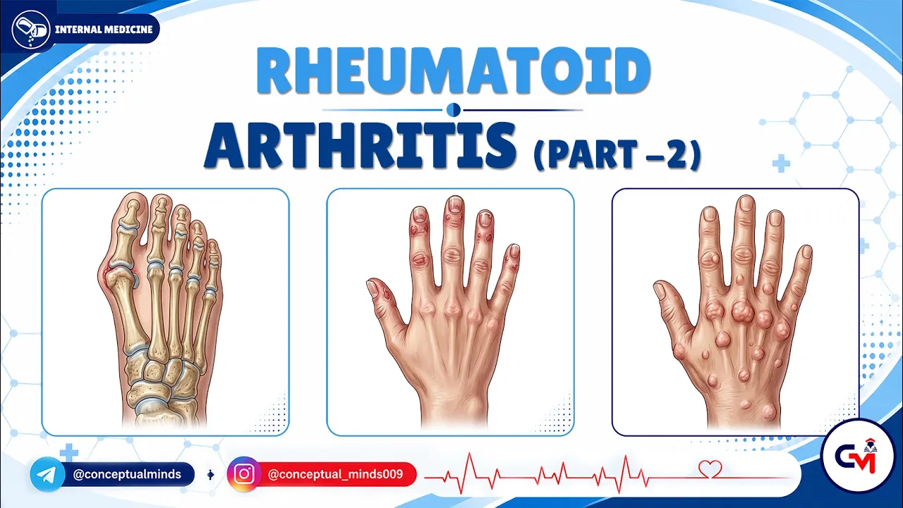 7. Rheumatoid Arthritis (Part 2) 🔥 Rheumatology USMLE Step 2 CK High-Yield Internal Medicine