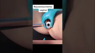 تضييق فتحة المهبل باليزر 