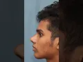 Download Lagu Best Result After Rhinoplasty In India | Before \u0026 After Results | Dr Mathew PC #shorts