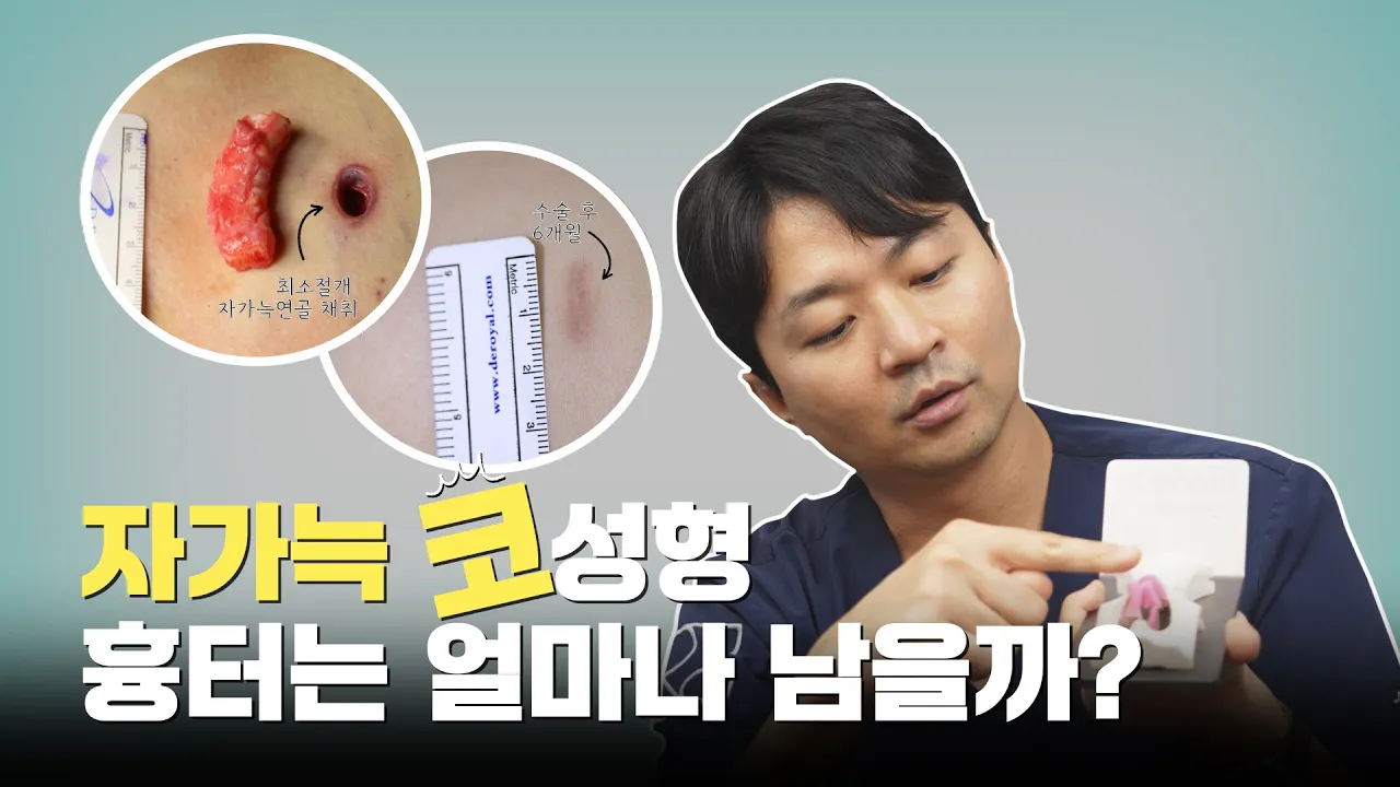 늑연골 채취 절개길이 11mm? [로이성형외과]