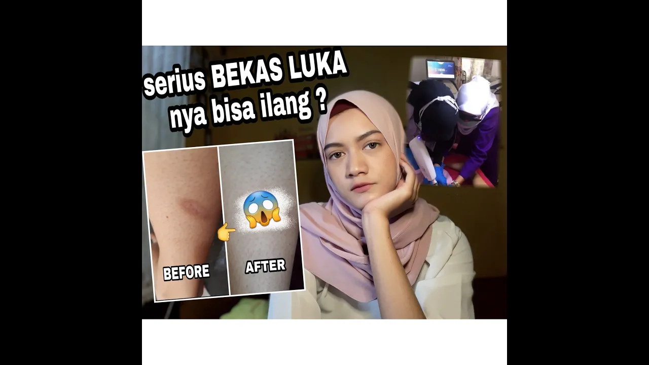 laserluka #4000jamtayang Hai semuanya aku di sini mau berbagi informasi untuk kalian yang pusing mik. 