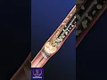 Download Lagu Removal of kidney stones through shockwave #shorts