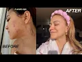 Lagu HOW TO GET RID OF HORMONAL ACNE (no meds): my skincare routine for clear skin 