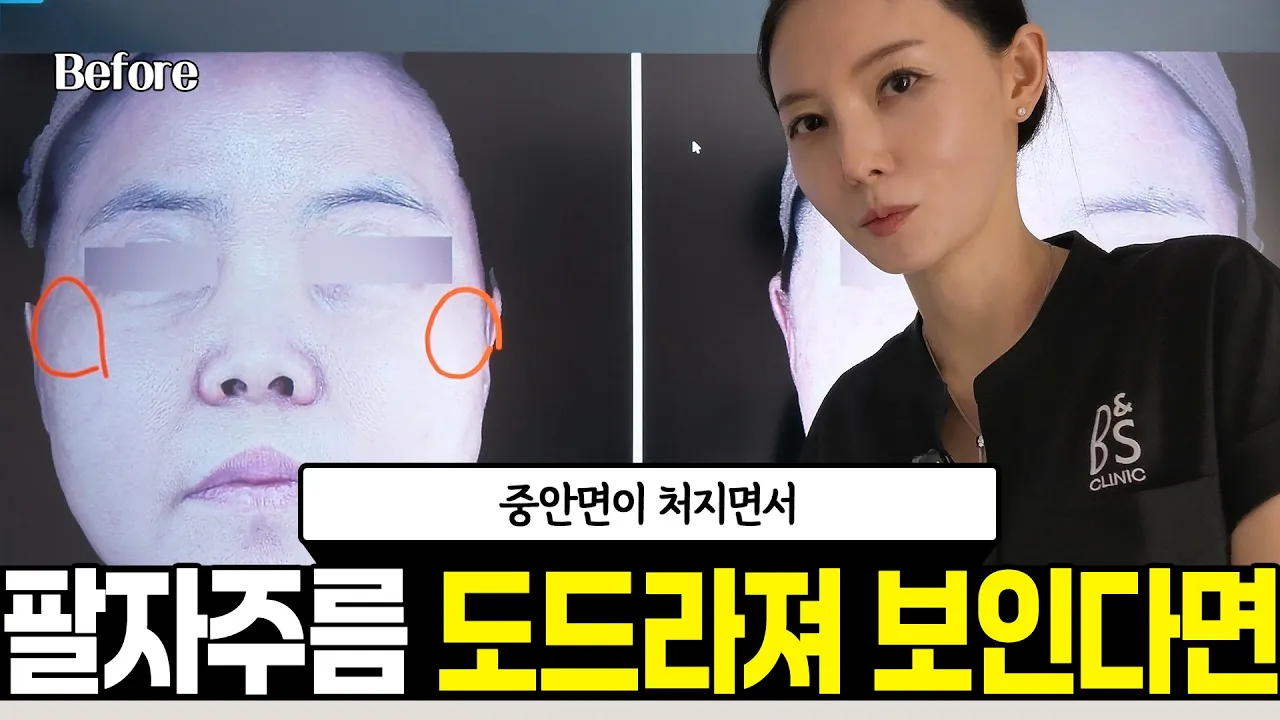 50대 후반 팔자주름 심부볼 처짐, 쥬브젠과 리프팅 시술 계획은?