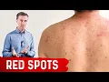 Why Red Spots on My Skin - Dr Berg on Skin Red Spots Causes Remedies