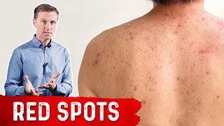 Why Red Spots on My Skin - Dr Berg on Skin Red Spots Causes Remedies