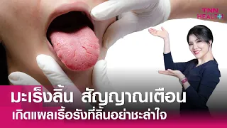  มะเร็งลิ้นเกิดจากอะไรบ้าง 