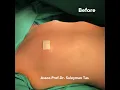 Download Lagu Breast Augmentation