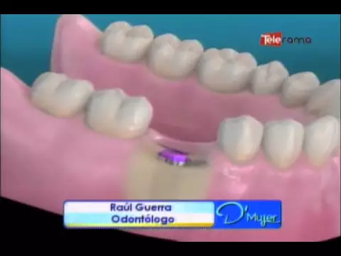 Riesgos de utilizar implantes dentales