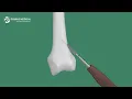 Video Operation of Titanium Elastic Nail