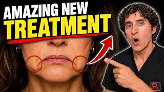 Marionette Lines & Downturned Mouth // Amazing New Treatment That Actually Works