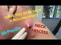 HAVE YOU EVER SEEN A ROLLING POP Giant neck abscess popped and the contents roll out into my hand