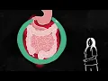 What to do if you have a Crohn's disease or ulcerative colitis flare | GI Society