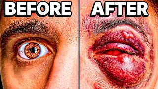 my eyeball is getting worse..