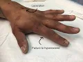 Repair of extensor Tendon CPT code - simplify medical coding