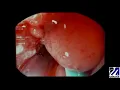 Download Lagu Endoluminal Vacuum-Assisted Therapy and TAMIS Closure of Leak following Ileal Pouch-Anal Anastomosis