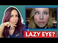 Does Kristen Bell Have A Lazy Eye Eye Doctor Explains