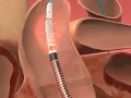 Impella Procedure
