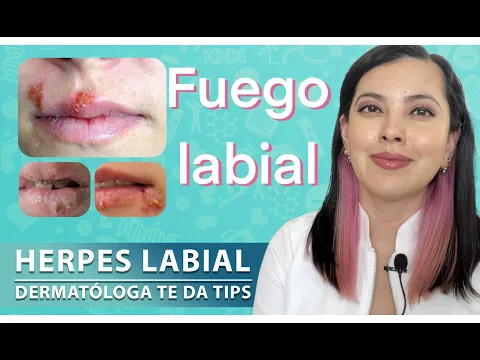 Download MP3 FUEGO LABIAL, datos que debes conocer, Tips de una Dermatóloga 👩🏻‍⚕️