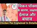 Chicken Pox in hindi Chicken pox Symptoms Dr K S Chougule