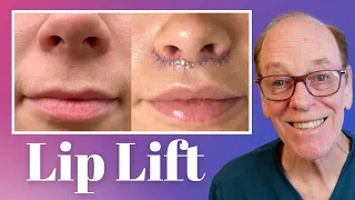 Plastic Surgeon's Guide to Lip Lift Surgery