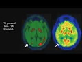 Imaging of Dementia and Alzheimer s Disease What You Need to Know - Sample