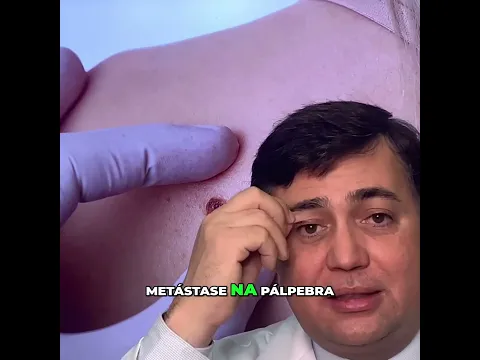 Melanoma: O perigo silencioso do câncer de pele #shorts