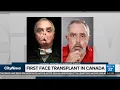 First face transplant in Canada