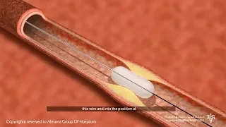 كيف تتم عملية قسطرة القلب 