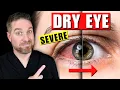 Lagu De beste behandelingen voor ernstige en chronische droge ogen!