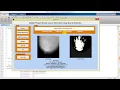 Breast Cancer Detection Using Neural Networks Matlab Project Source Code