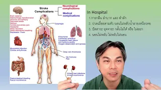 ทำไมการเป็นอัมพาตซีกหนึ่งถึงส่งผลต่อความคิดและการกระทำด้วย