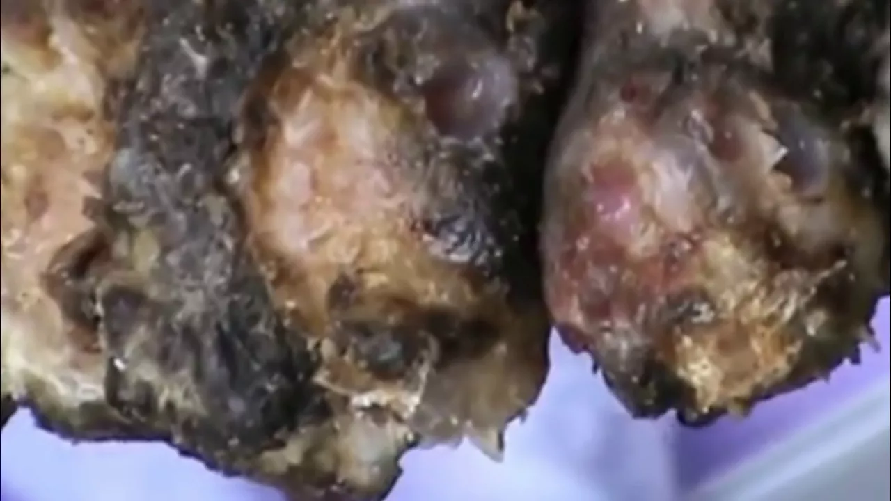 Andrew's jigger Removal! (Part 2) Worst Case Seen To Date