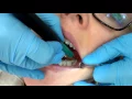 Prophylaxis Tips with the Ultrasonic