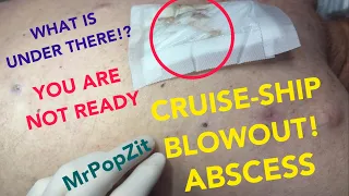 Cruise ship blowout!When I lifted the bandage I couldn’t believe how much had popped out!Get ready!