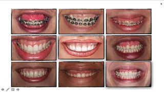 SORRISO GENGIVAL
