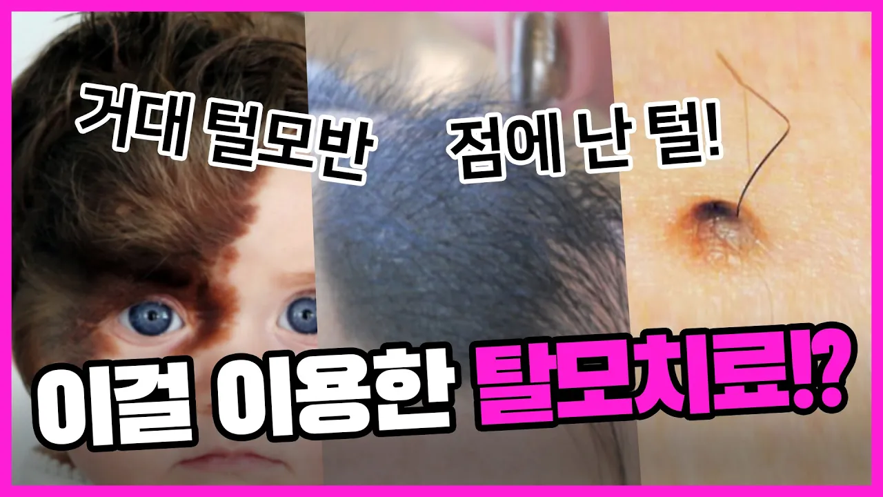점털(털모반)을 이용한 탈모치료 연구!ㅣ뉴헤어