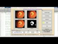 Glaucoma Detection Using Image Processing Matlab Project Source Code Glaucoma Classification