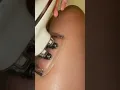 Cellulite Treatment