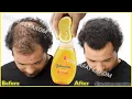 Download Lagu Put these ingredients in your shampoo,🍋 it accelerates hair growth and treats baldness