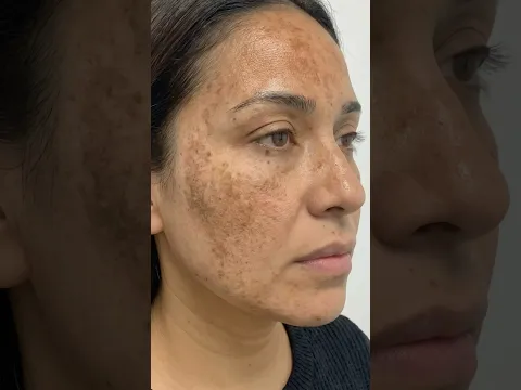 Potato Face Spray for Dark Spots & Pigmentation 🥔✨ #ashortaday