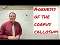 Agenesis of the corpus callosum