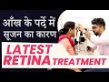 Download Lagu Latest Retina Treatment for Cystoid Macular Edema (CME) and Decentred IOL | आँख के पर्दे में सूजन