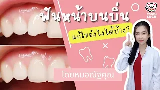  ฟันหน้าบิ่น หรือสีหน้าบนดินต้องจัดฟันไหม 